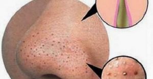 Mẹo tự loại bỏ mụn đầu đen ngay tại nhà