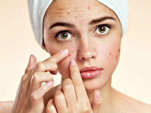 Dùng tinh dầu xả xông hơi trị mụn như thế nào hiệu quả