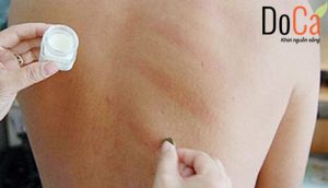 Cạo gió, xông hơi. Trị trúng gió, cảm cúm và những điều cần biết